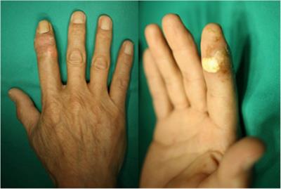 Surgical management of chronic calcific deposit resembling tendon sheath infection in the index finger: A rare case report and literature review